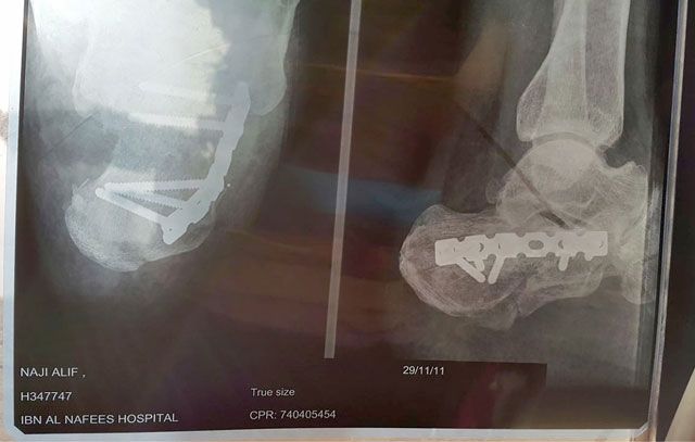 صورة أشعة توضح إصابة ناجي فتيل في قدمه