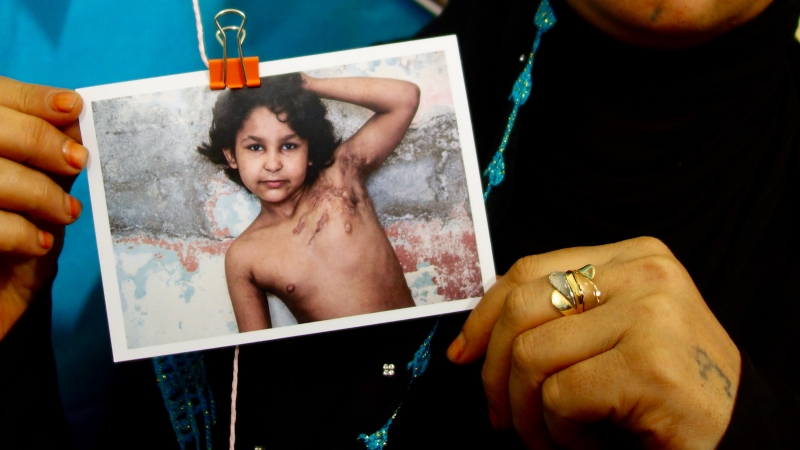 أم تعرض صورة تظهر ندبات على جسم ابنتها بعد تعرضها لهجوم في سوريا، كجزء من مشروع مع مؤسسة 