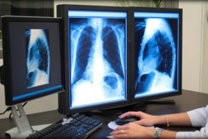 مخاوف من إصابة 10 آلاف شخص بفيروس هانتا القاتل بأمريكا 