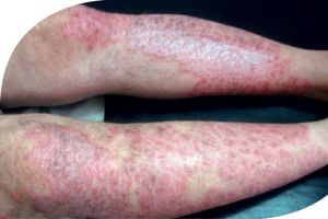 29 أكتوبر اليوم العالمي للصدفيـة