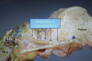اكتشاف رباط جديد لاستقرار الركبة