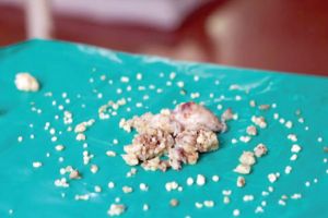 جراحون يقتلعون 232 سناً من فم هندي