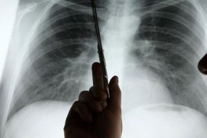 اختبار تشخيصي جديد يرحم مرضى سرطان الرئة من إجراء جراحي خطير