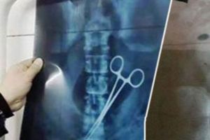 السلطات السعودية تعثر على مقص في بطن حاج نيجيري