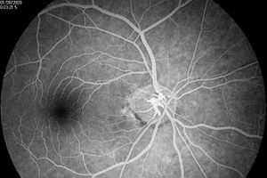 داء 'السكري' غير المعالج يمكن أن يؤدي إلى فقدان البصر