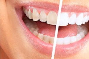 تعرف على أضرار التبييض العشوائي للأسنان