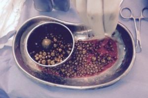 غرائب الطب.. استخراج 400 'حصوة' من مرارة مريضة