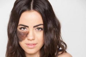 نصائح قيمة لإزالة الوحمة بطرق طبيعية