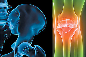 أكثر من 200 مليون شخص حول العالم يعانون من هشاشة العظام 'المرض الصامت'