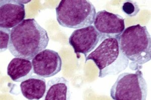 سعودية تتفوق في أبحاث «سرطان الدم الليمفاوي»