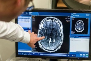 العلماء يخترقون حاجز المخ لعلاج المرضى