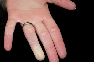 'أصابع الموتى' تهاجم النساء في الشتاء!