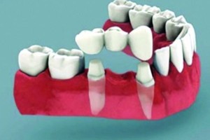 جل مبتكر لحشو الأسنان