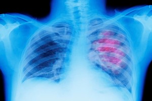 باحثون أمريكيون يتوصلون إلى علاجاً ثلاثياً مركباً لـ «سرطان الرئة»