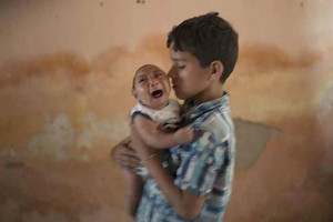 أطفال مشوهون بفيروس 'زيكا' بالبرازيل يعانون تلفا بحاستي السمع والبصر