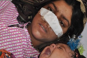 أفغانية تخضع لجراحة بتركيا بعد أن جدع زوجها أنفها