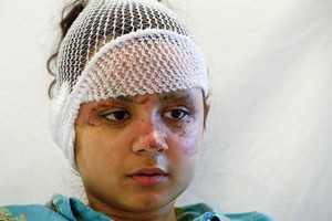 بالصور... شابة فرنسية أصيبت بتفجير مطار بروكسل: كان الأمر أشبه بنهاية العالم