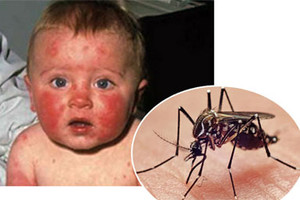 تسجيل أول حالة وفاة مرتبطة بفيروس زيكا على أراضي الولايات المتحدة