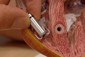 الكبسولة القلبية... تدعم نبض القلب عند الضرورة وتزوده بالكهرباء اللازمة