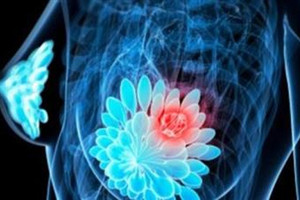 كيف تحمين نفسك من سرطان الثدي؟