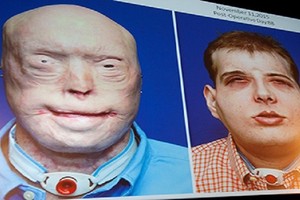 تفاصيل أنجح عملية جراحية لزرع الوجه