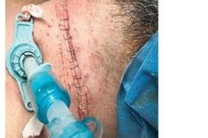 مستشفى سعودي ينقذ كويتياً حاول الانتحار