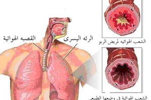 عقار جديد للربو يحدث انقلابًا في علاج المرض
