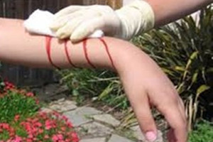 7 طرق للتعامل مع النزيف الدموي الخارجي للأطفال