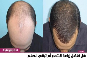 هل تفضل زراعة الشعر أم تبقي الصلع أم استخدام الشعر المستعار؟