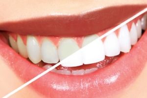 إن كنتِ تعانين من شفاهٍ داكنة .. الليزر المائي العلاج الأحدث