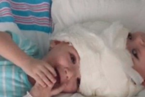 جراحون في نيويورك يفصلون توأمين ملتصقين من الرأس عمرهما 13 شهرا