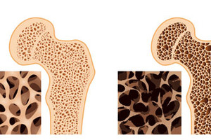'آي أو أف' تحذر من الاستهانة بخطورة مرض هشاشة العظام