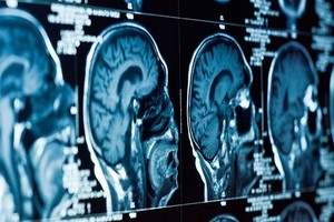 العلماء يحددون مصدر الاكتئاب في الدماغ