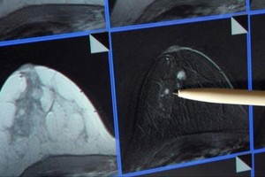 سبل الوقاية من السرطان.. 'وحش' العصور الحديثة