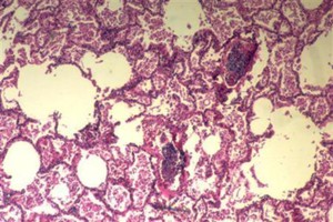 سبل الوقاية من السرطان