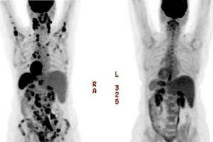 الليمفوما... سرطان يكتسح الأنسجة الليمفاوية