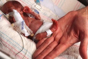 خالفت التوقعات الطبية وتم تسليمها إلى والدتها ووزنها أقل من كيس سكر!