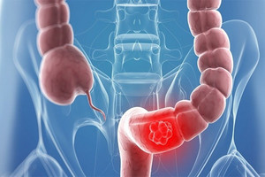 طرق فعالة للكشف المبكر عن سرطان الأمعاء