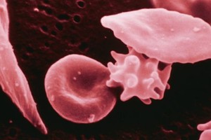 تسجيل اول حالة شفاء لمراهقة من الانيميا المنجلية 'السيكل سل' تفتح الباب أمام الأمل في علاج الملايين