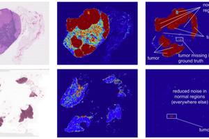 'غوغل' تساعد الأطباء على تشخيص مرض السرطان