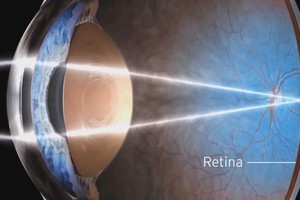 ثلاث نساء يفقدن بصرهن في اختبار طبي غير مرخص له في الولايات المتحدة