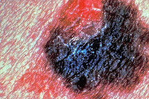 دراسة أميركية: ثلثا أنواع السرطان نتيجة أخطاء جينية عشوائية