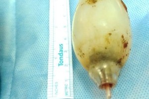 بعد 11 عاماً.. استخراج «لمبة إضاءة» من أمعاء آسيوي